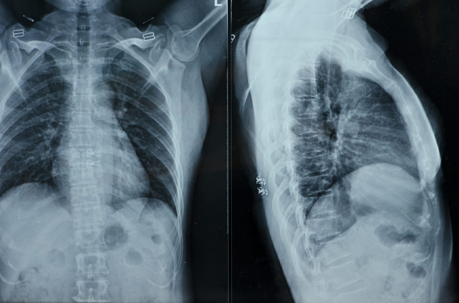 x-rays-2025-03-15-08-45-19-utc
